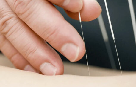 What Conditions Can Be Treated With Dry Needling