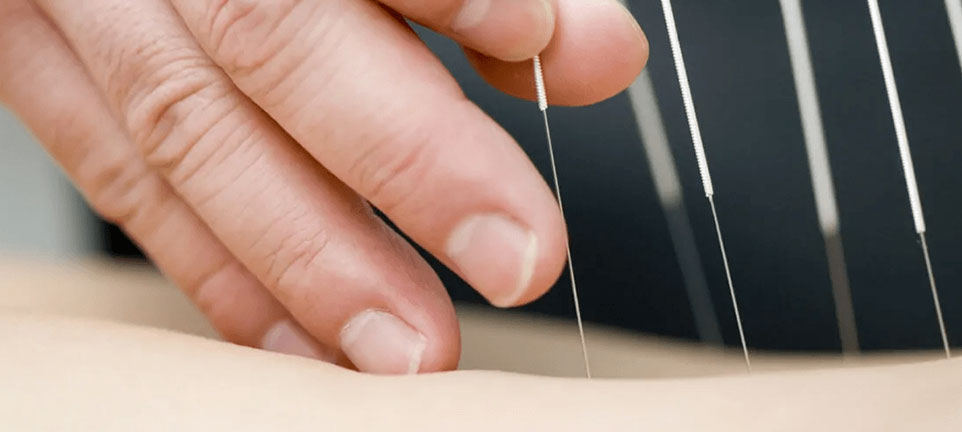 What Conditions Can Be Treated With Dry Needling