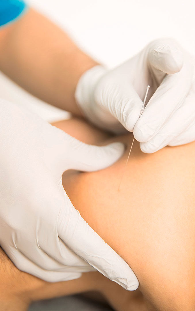 Dry Needling